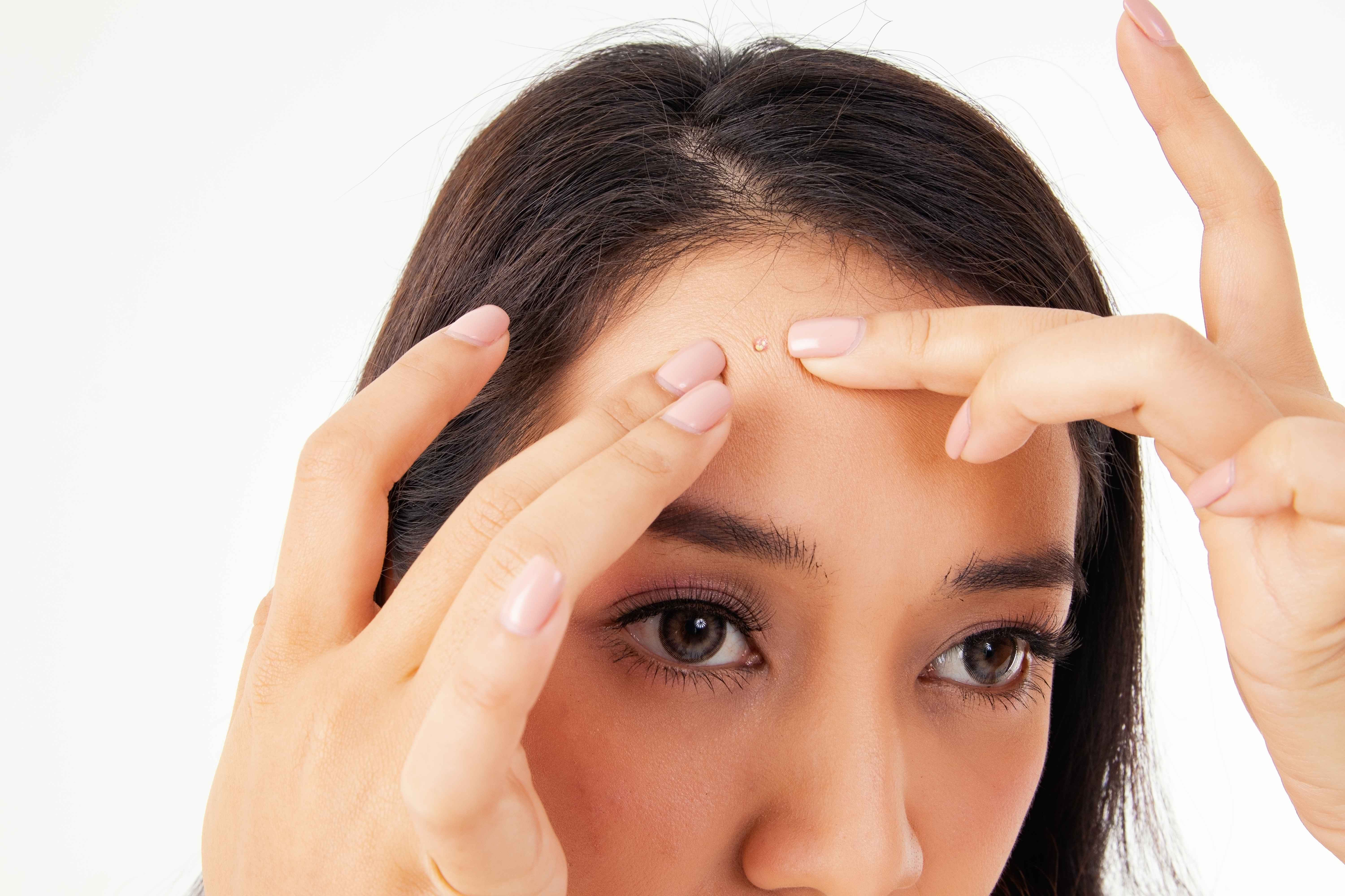 Get Rid of Clogged Pores on Your Forehead: Tips and Tricks
