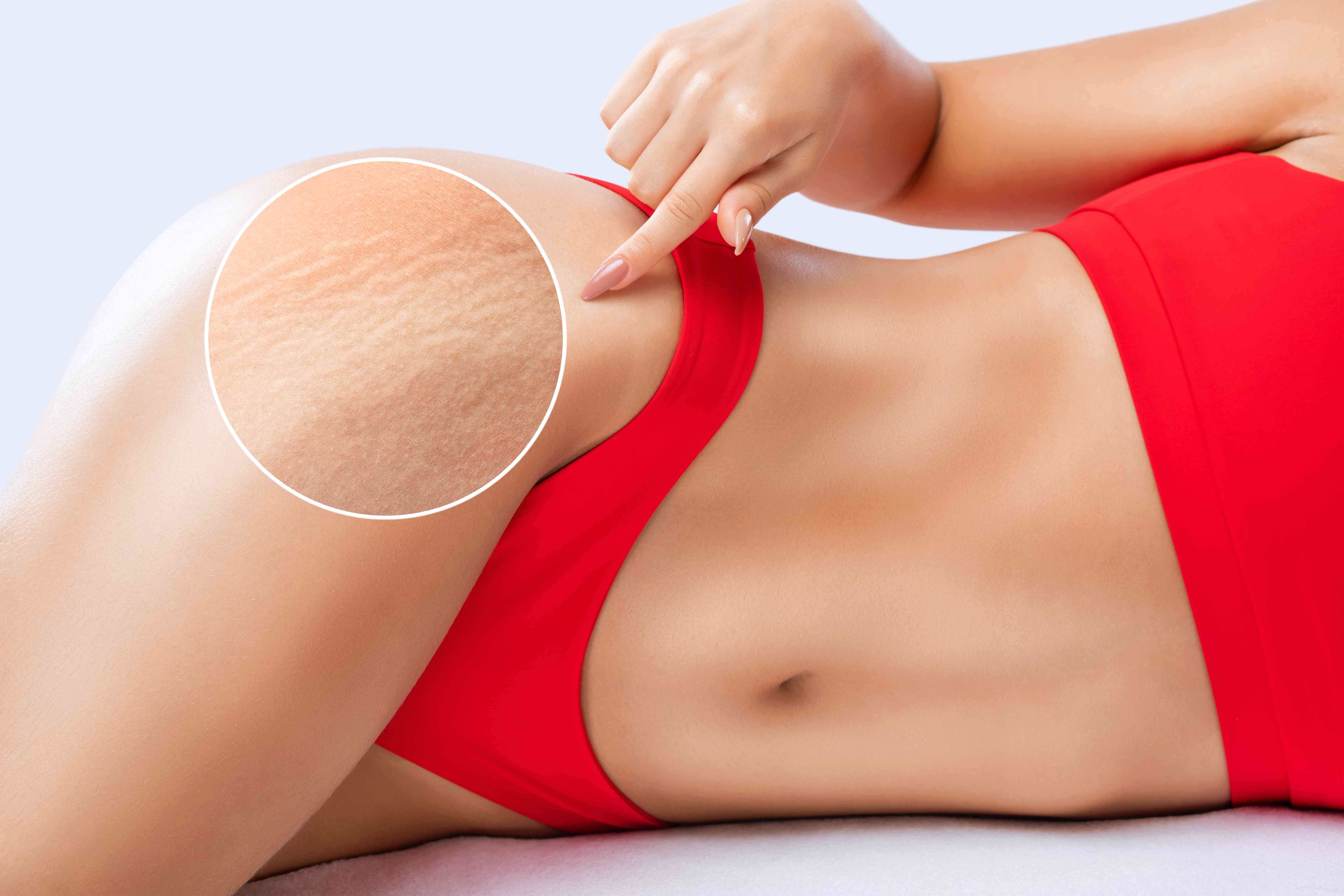 6 Natural and Effective Ways to Get Rid Of Stretch Marks